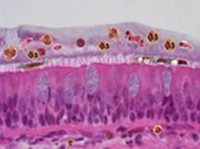 Schematic of inner lung surface in disease
